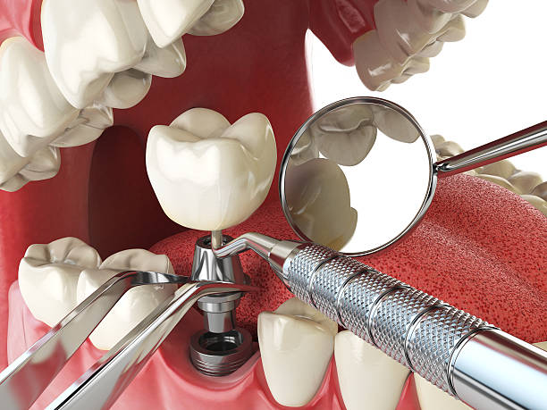 Best Emergency Dental Care for Broken or Chipped Teeth in Harb, OR